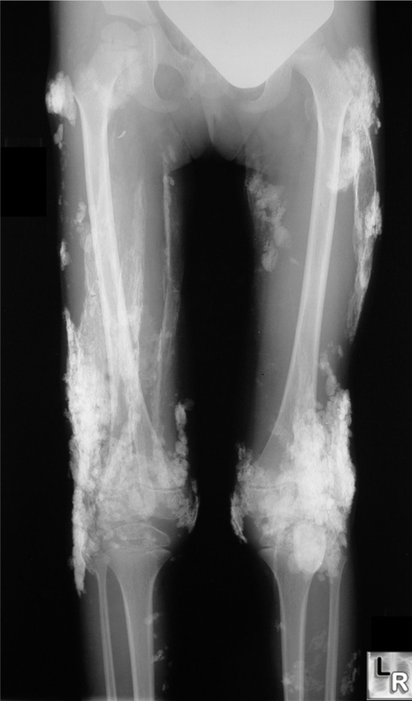 Dermatomyositis.