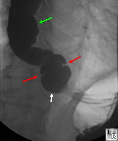 Hiatal Hernia Cxr