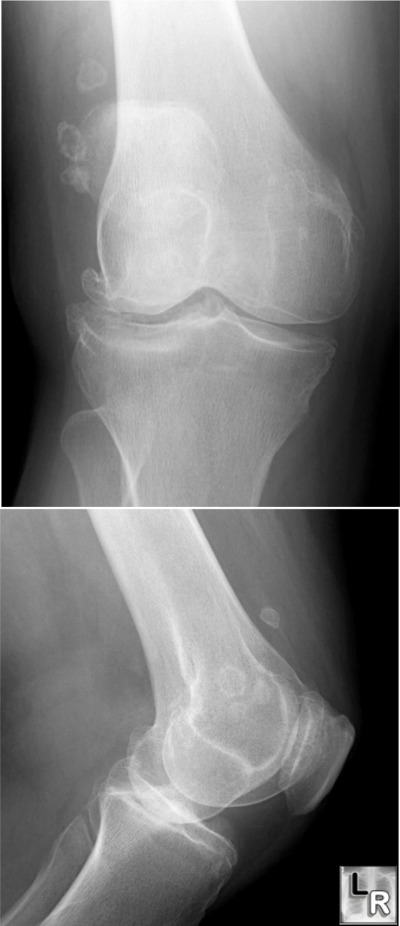 osteoporosis x ray. o Usually no osteoporosis