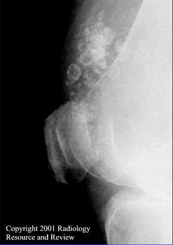 Synovial Chondromatosis