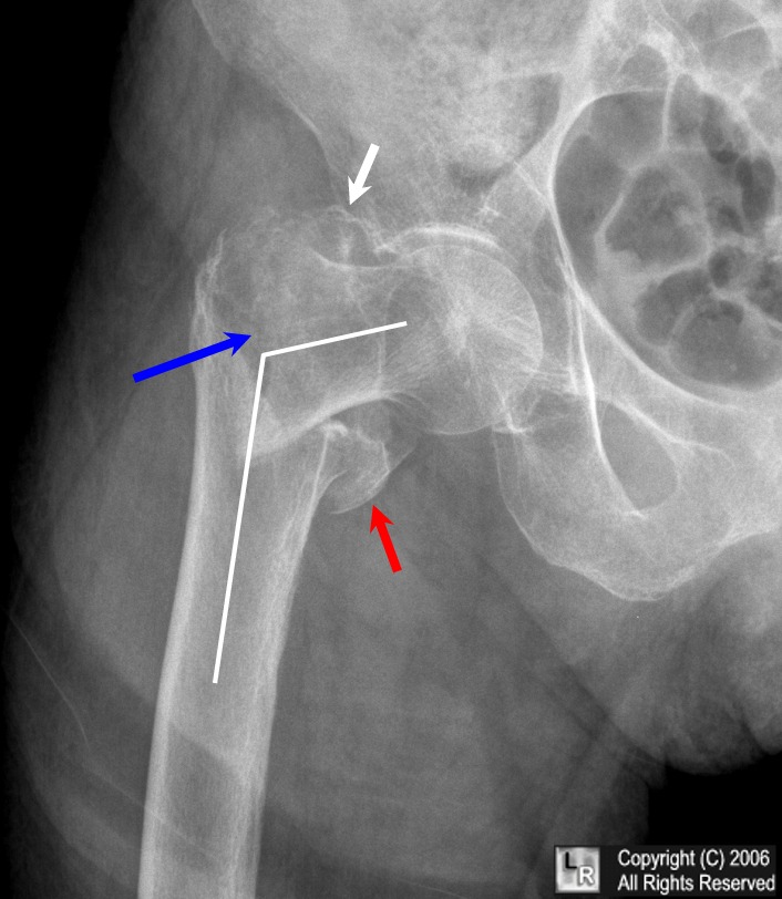 Comminuted intertrochanteric fracture