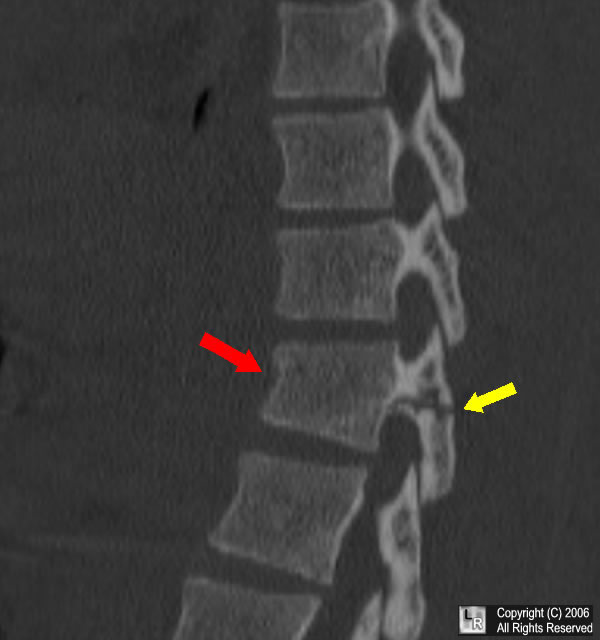 LearningRadiology - chance, fracture, spine, mvc, mva