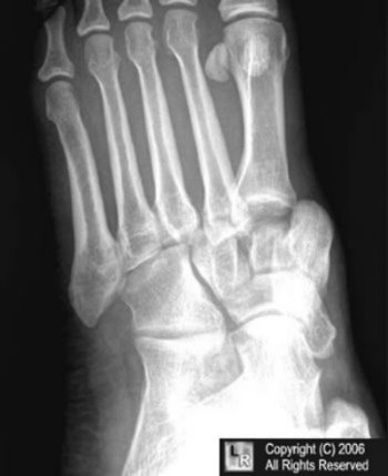 Lisfranc Fracture Dislocation