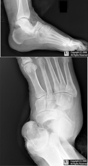 Chopart's fracture dislocation