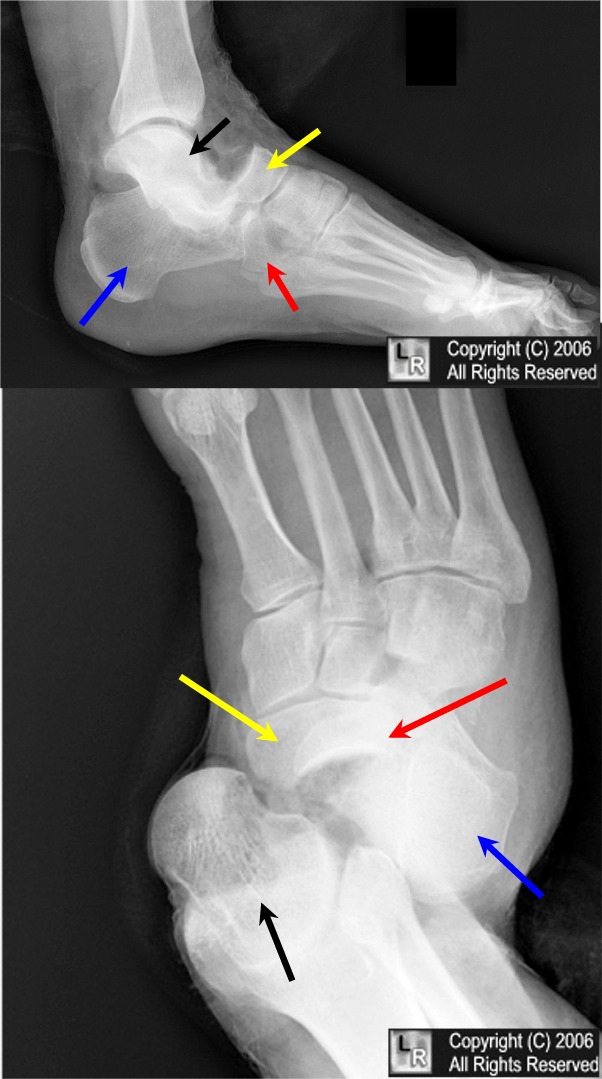 fracture talus