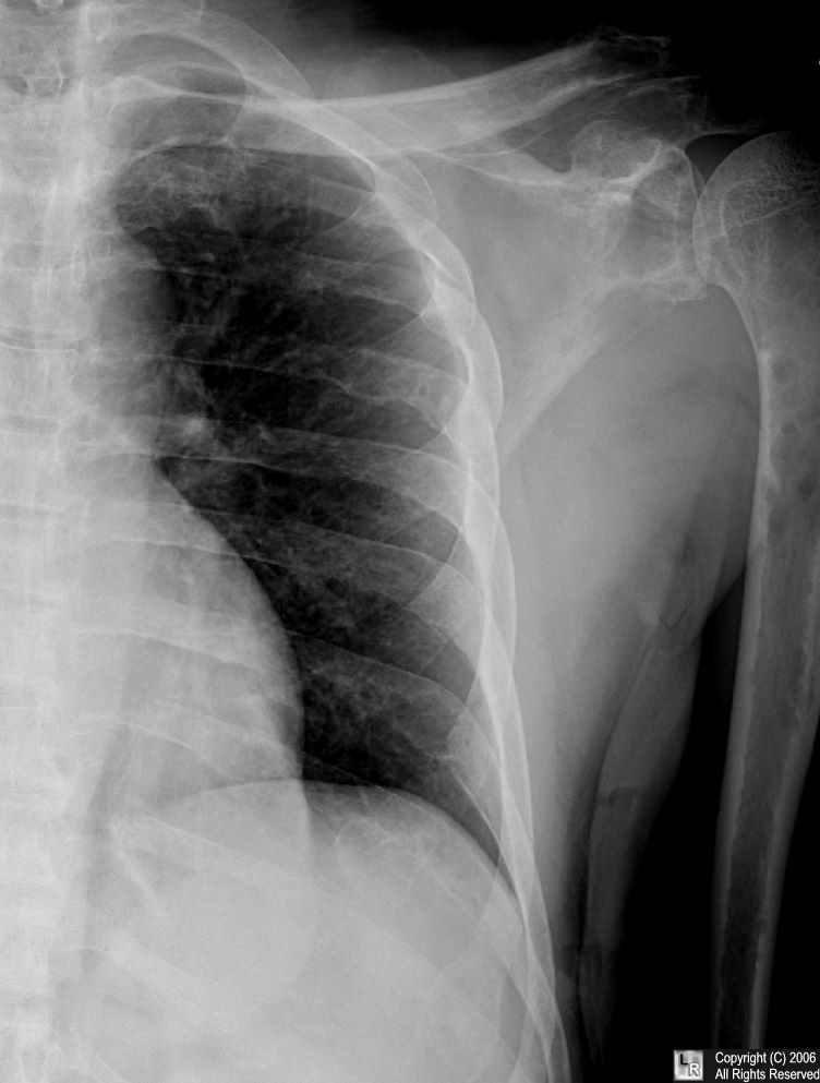 Multiple myeloma-ribs