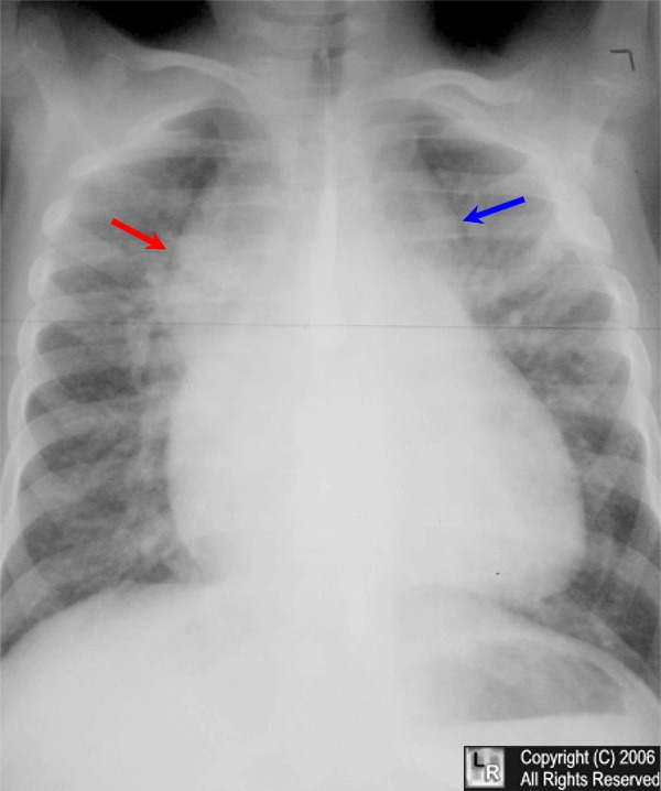 Total Anomalous Pulmonary Venous Return