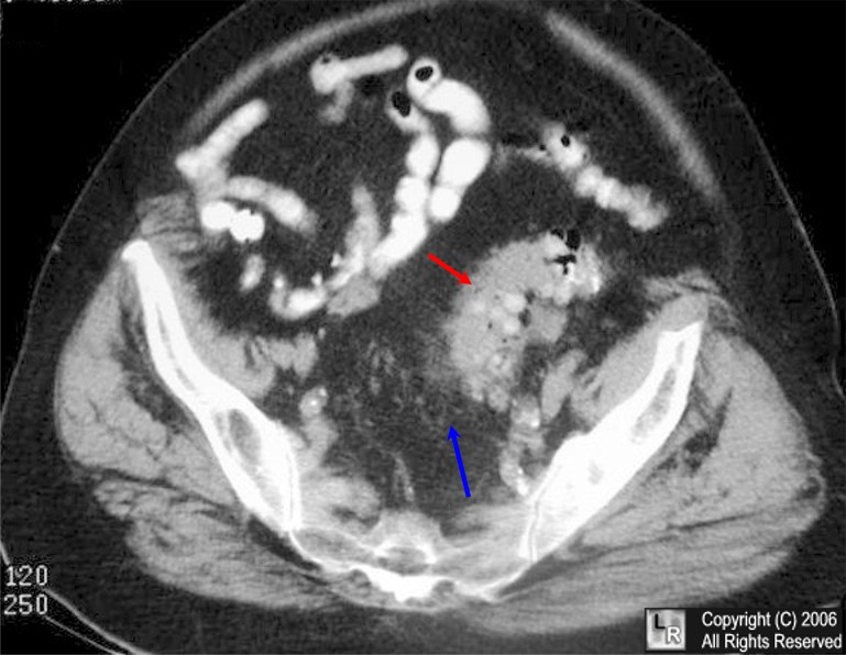 diverticulitis image jpg