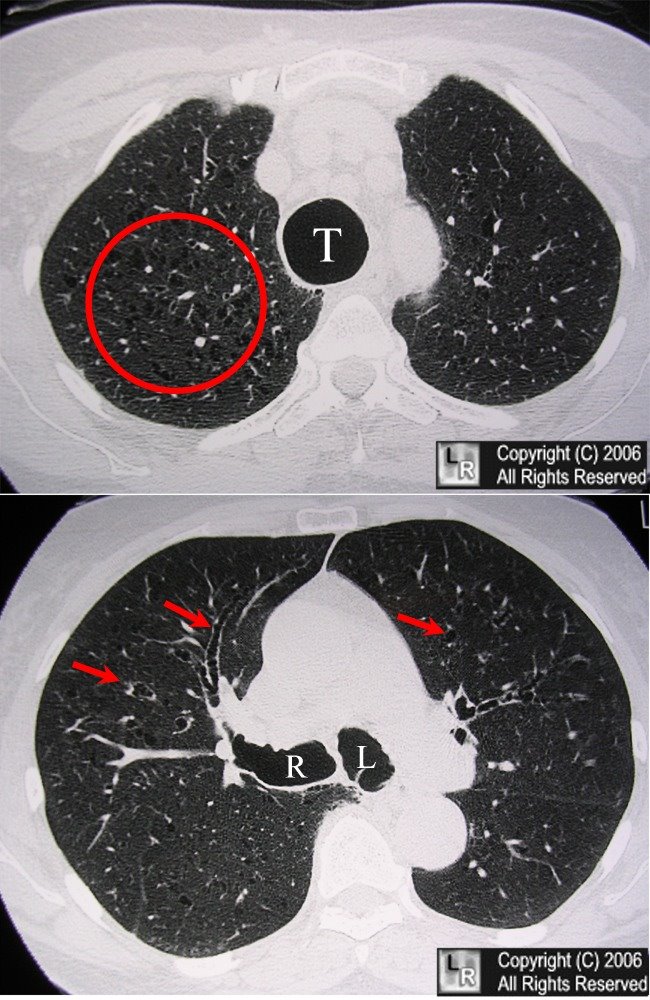 Munier-Kuhn Syndrome Munier-Kuhn Syndrome image .jpg