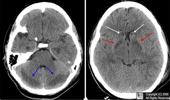http://www.learningradiology.com/caseofweek/caseoftheweekpix2006/cow232arr.jpg