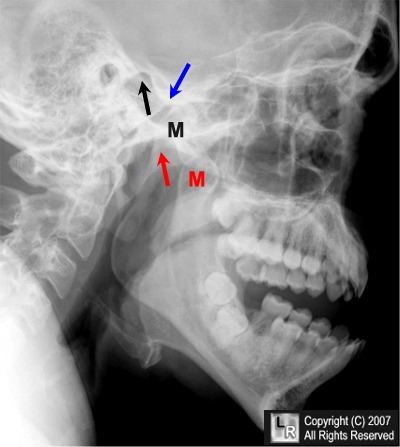 Dislocated mandible, image