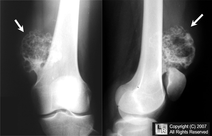 Dysplasia Epiphysealis Hemimelica. Osteochondroma.