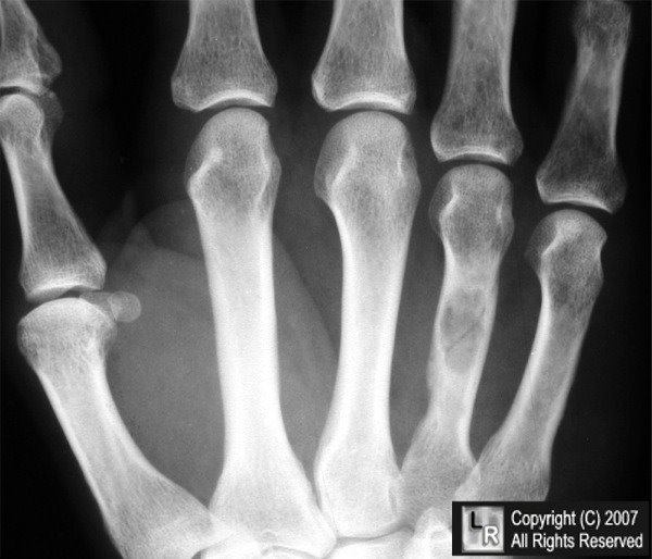 Sarcoid - close-up of the skin lesions: MedlinePlus ...