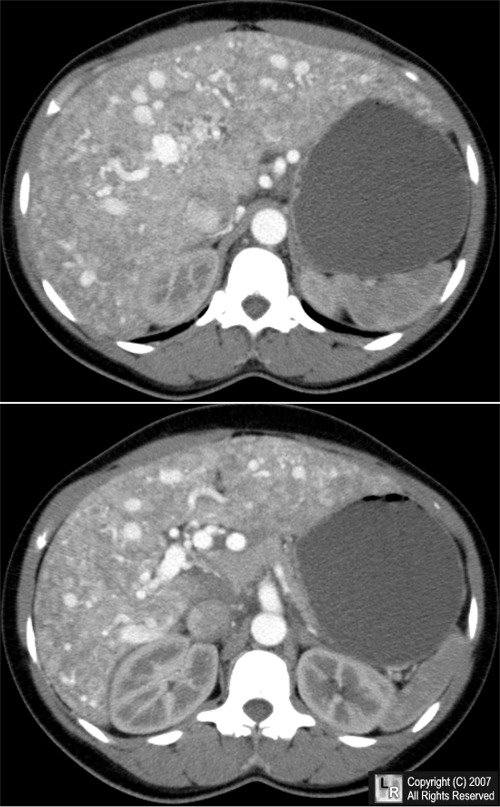 Splenic cyst; Gastric outlet