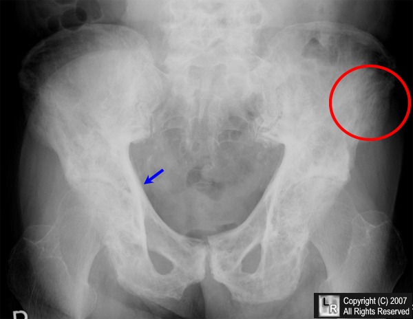 Paget's Disease -- pelvis