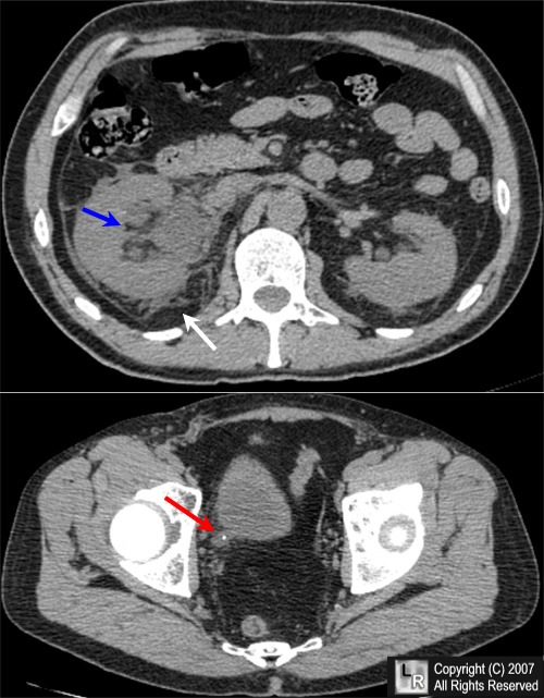 Ureteral Calculus