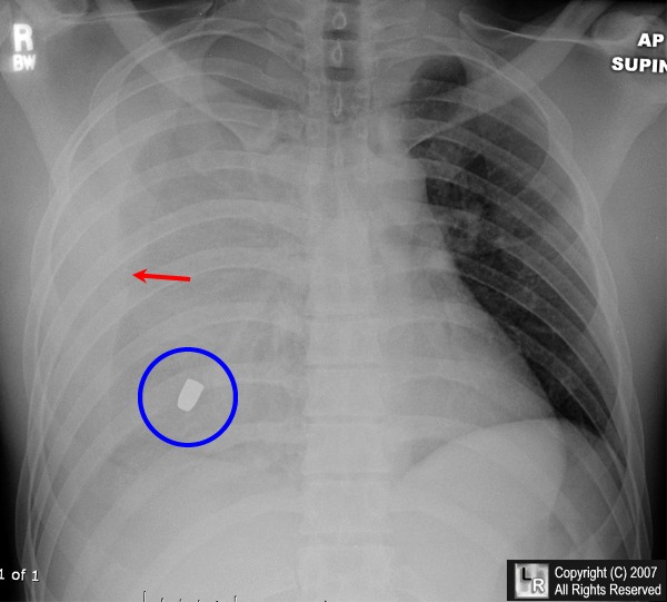 Hemothorax