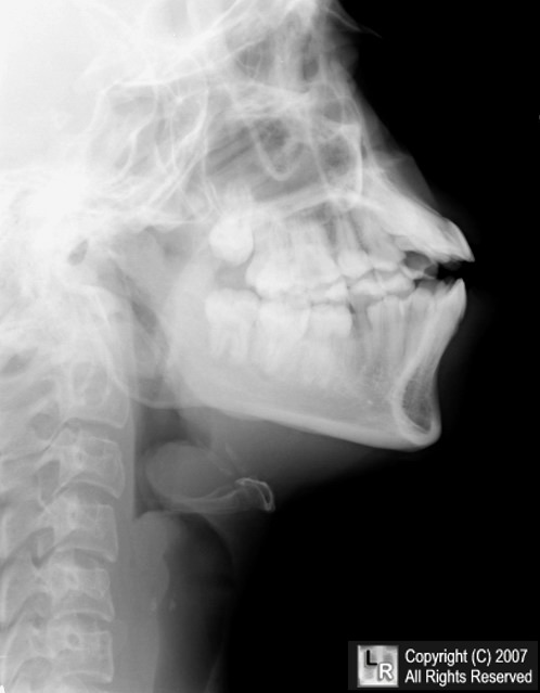 Epiglottitis.