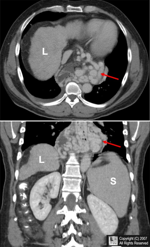 Esophageal Varices