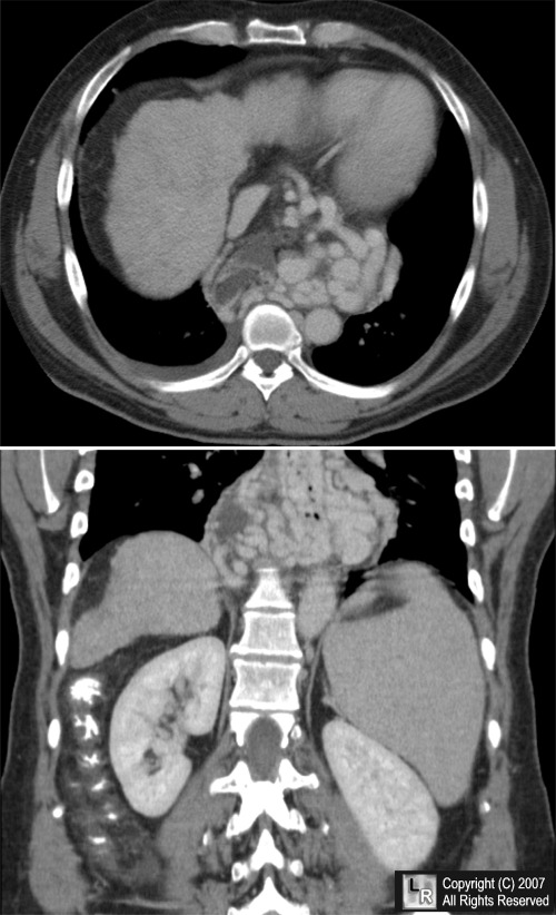 varices esophageal