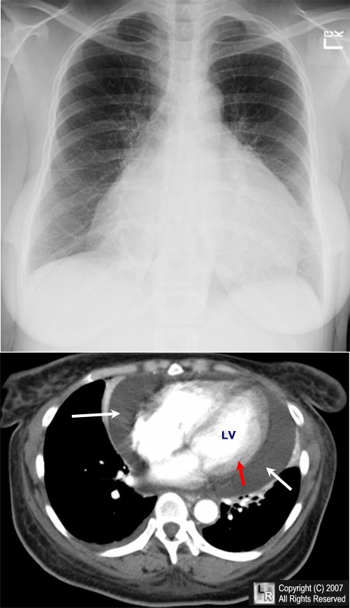 Pericardial effusion