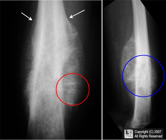 Classic x-ray findings shown in this child with leg pain
