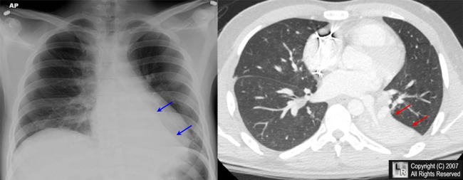 Left lower lobe atelectasis