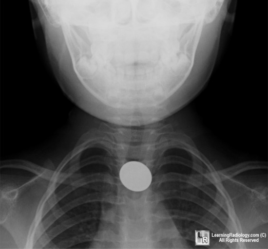 Coin In Esophagus