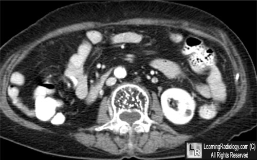  Hemangioma of spine; Duplicated collecting system; Appendicitis