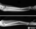 Plastic Bowing of Bone