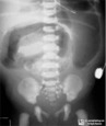 Meconium Ileus