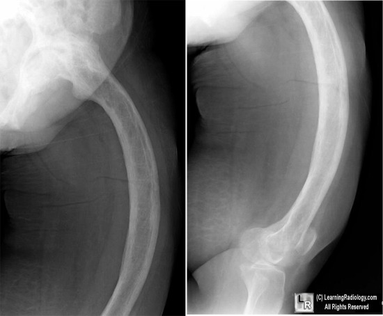 Bowing of Femur in Paget's