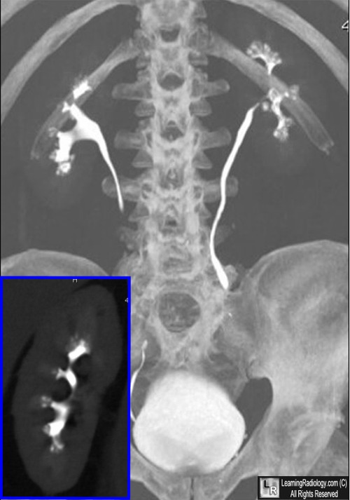 right renal calculus