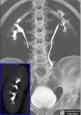 Medullary Sponge Kidney