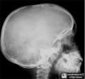 Eosinophilic Granuloma