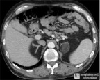 Adrenal Myelolipoma