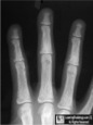 hyperparathyroidism