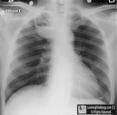 Infected bulla