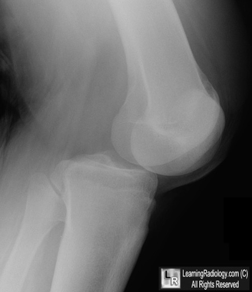 Blount's disease; Patellectomy; Fong's disease; Dislocated knee 