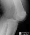 Dislocated knee
