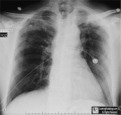 laryngectomy