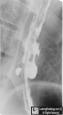 HIV esophagitis