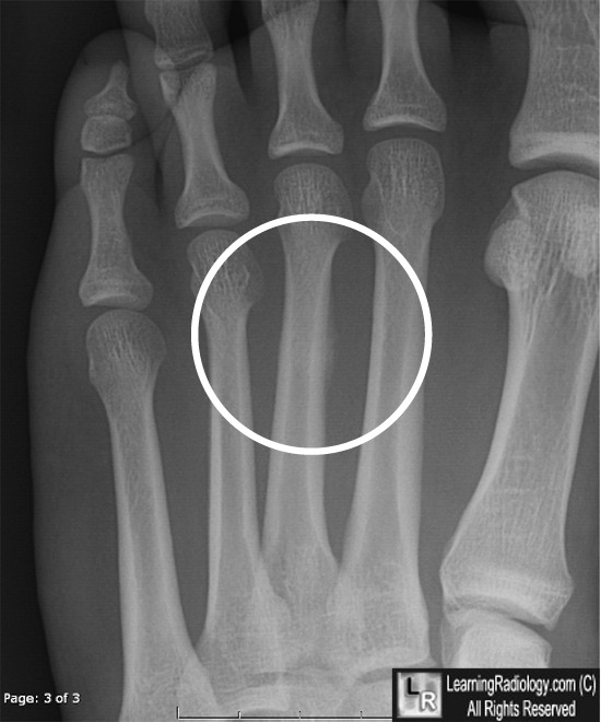 stress, fracture, march,