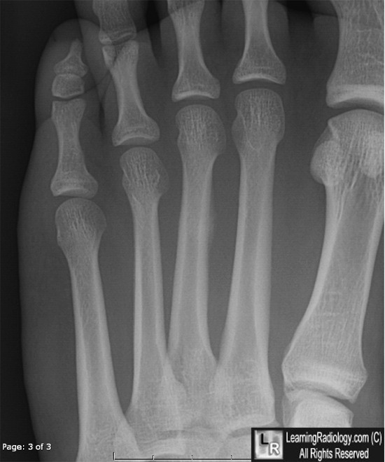 Metatarsal Stress Fracture Mri. Stress fracture of the 3rd