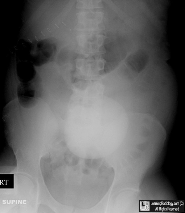umbilical hernia in adults. Ventral hernia