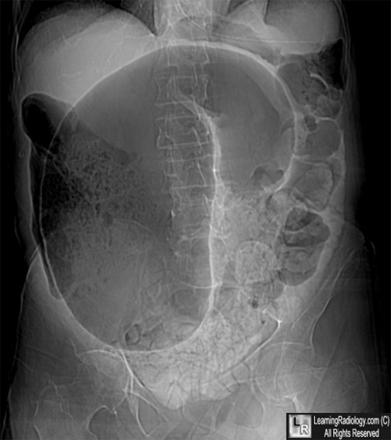 LearningRadiology Sigmoid Volvulus