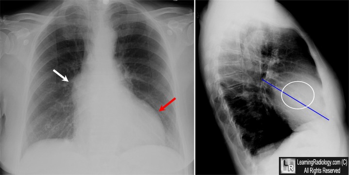 Learningradiology Aortic Stenosis Stenotic Valve As