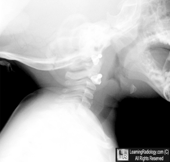 Croup; Epiglottitis