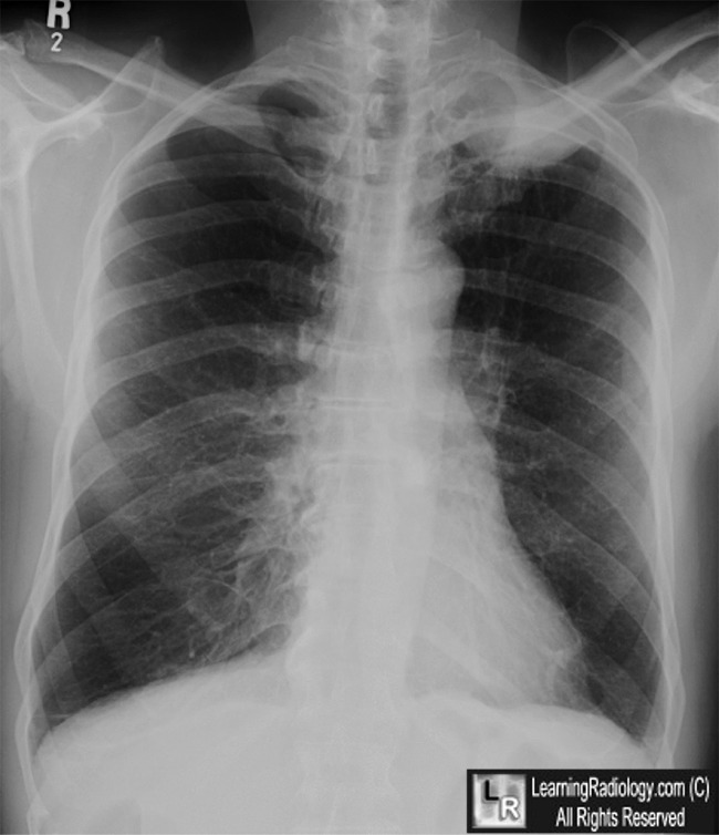 subclavian aneurysm