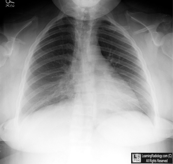  Right middle lobe pneumonia; Thyroid goiter; Congestive heart failure